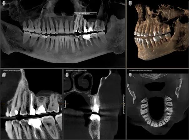 Расшифровка КТ зубов - 2 стоматологических сегмента