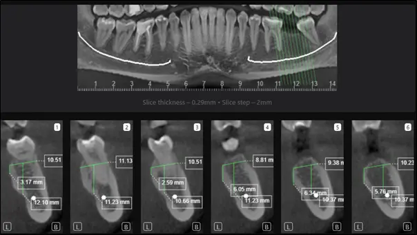 Разметка для планирования операции имплантации в области одного отсутствующего зуба