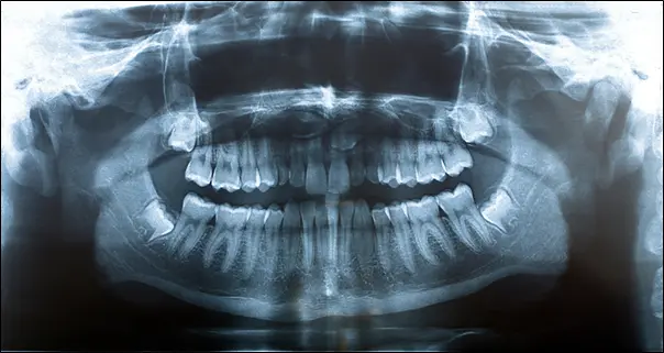 Рентгенологический паспорт зубов по КТ двух челюстей и ВНЧС