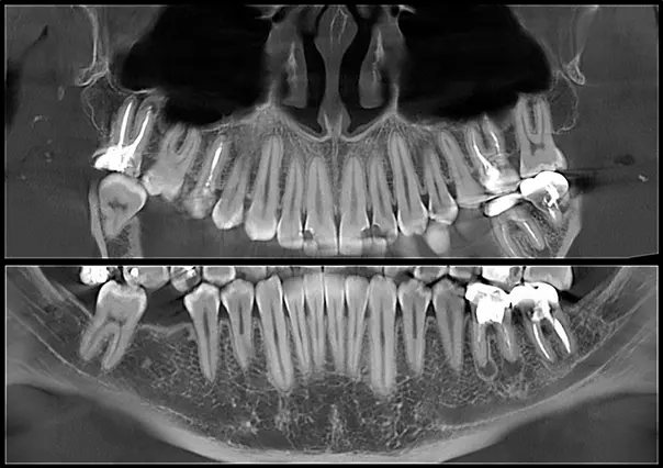 Спиральная КТ зубочелюстной области