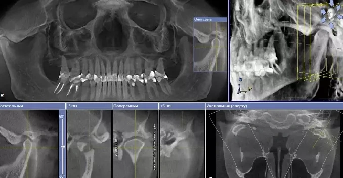 КТ - Височно-нижнечелюстные суставы (ВНЧС)