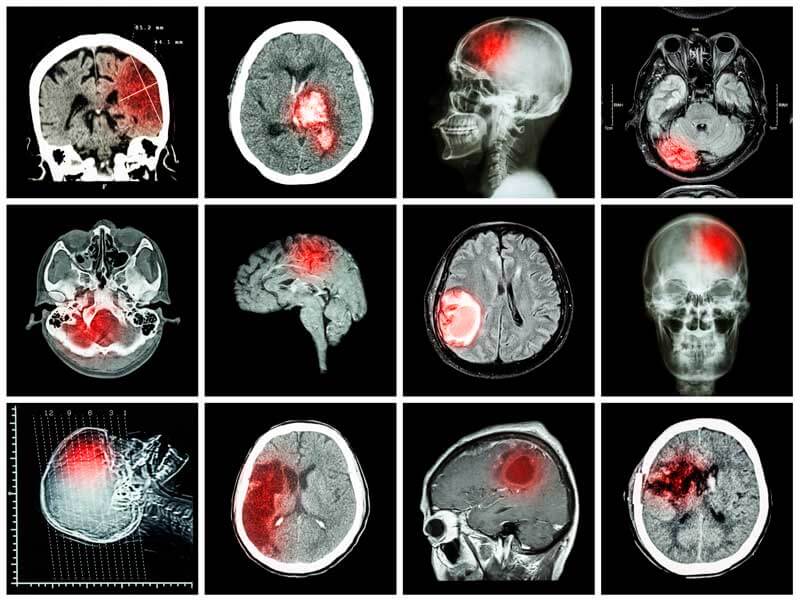 Расшифровка КТ головного мозга